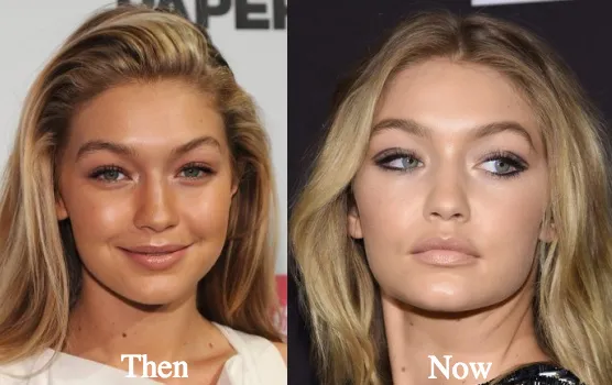 Gigi Hadid nose job fillers